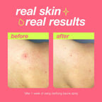 Dermalogica Clarifying Bacne Spray 6oz