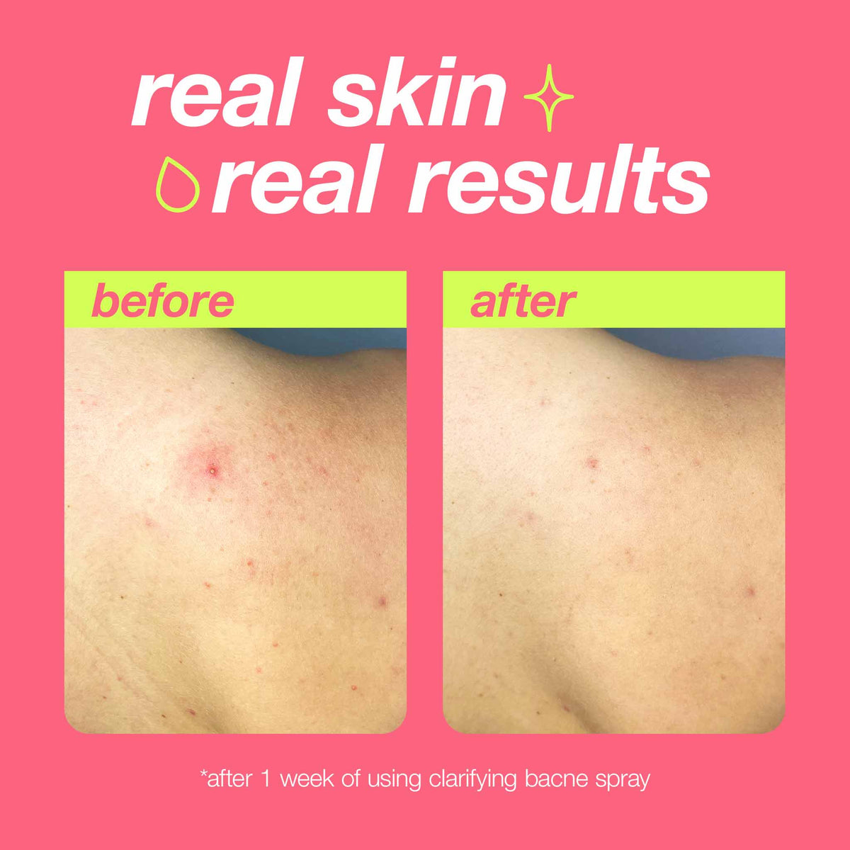 Dermalogica Clarifying Bacne Spray 6oz
