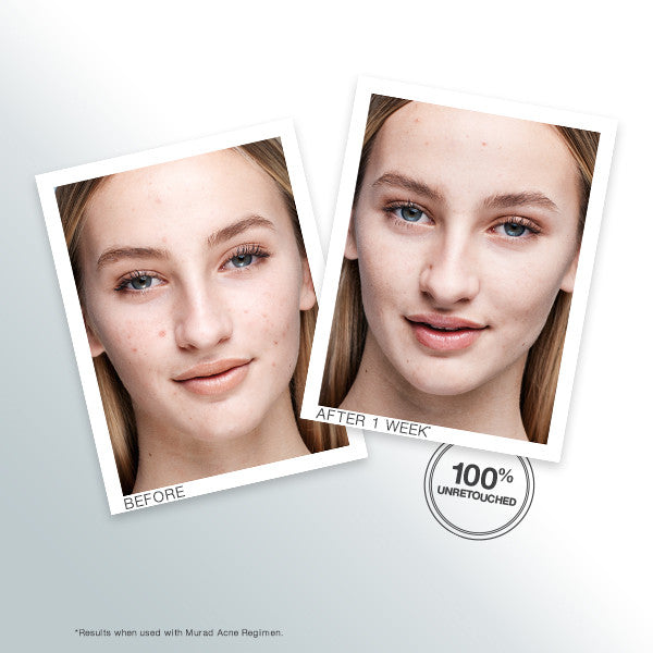 Murad Outsmart Acne Clarifying Treatment