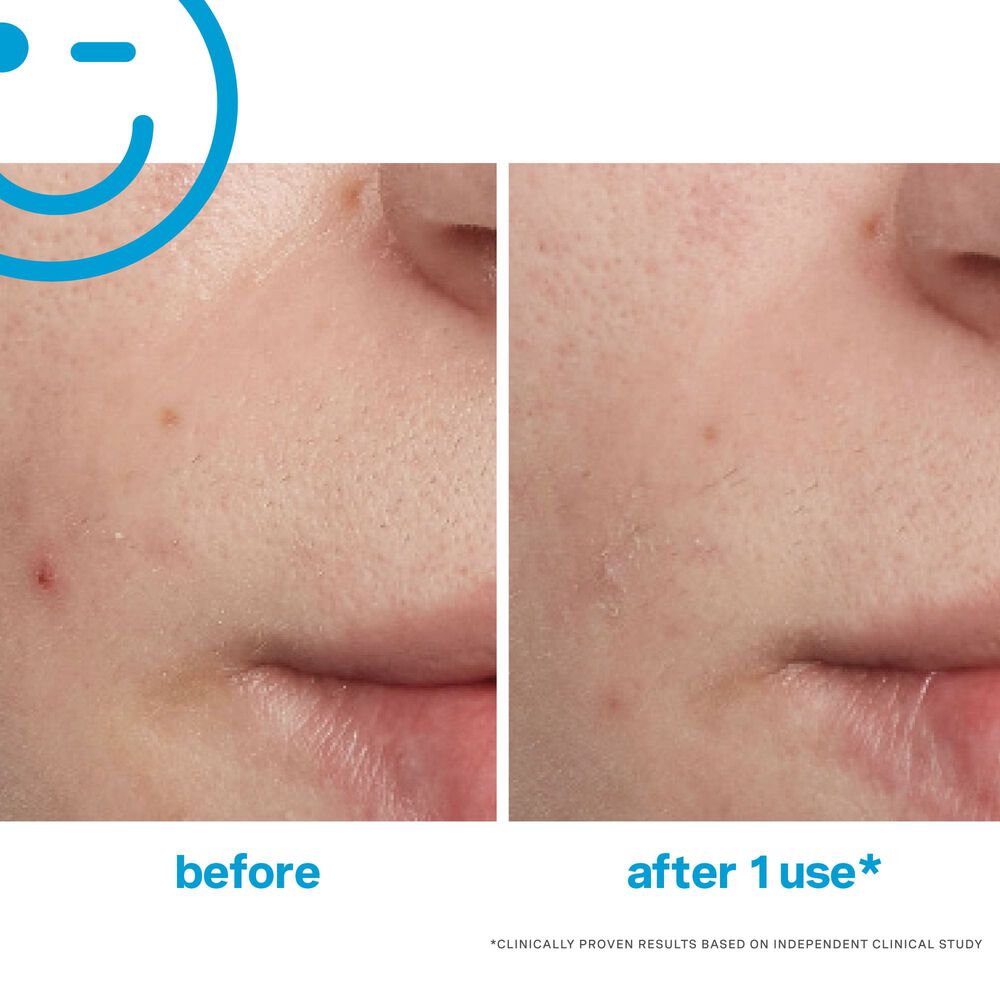 Kate Somerville EradiKate Acne Treatment 1oz