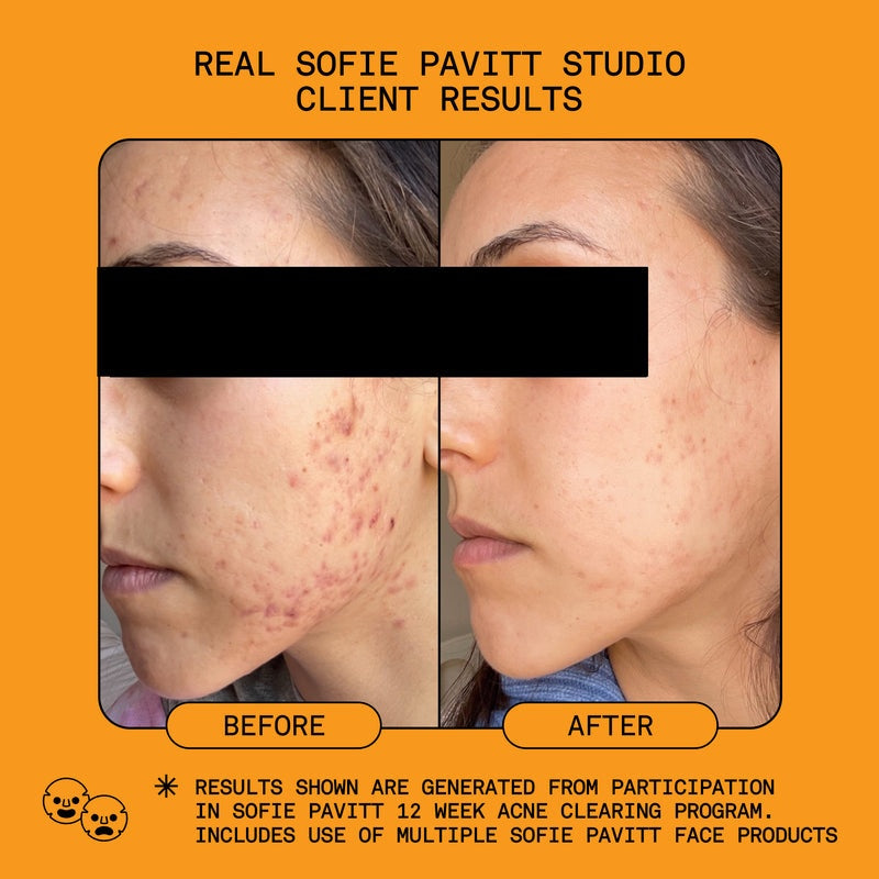 SOFIE PAVITT FACE Reset 5% Benzoyl Peroxide Acne Treatment 1oz